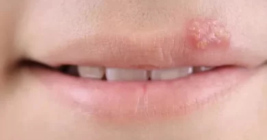 Cold Sores