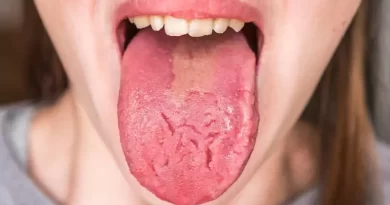 Fissured Tongue